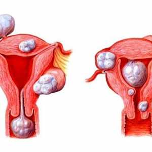 Vrste maternični fibroidi