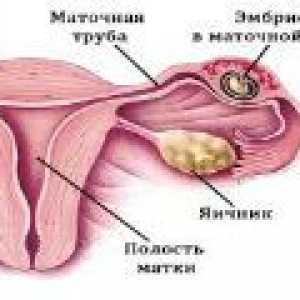 Zunajmaternične nosečnosti: simptomi, znaki, zdravljenje