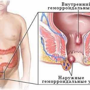 Notranji hemoroidi - simptomi