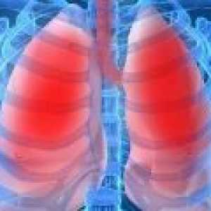 Pljučnica pri odraslih: Simptomi, Zdravljenje