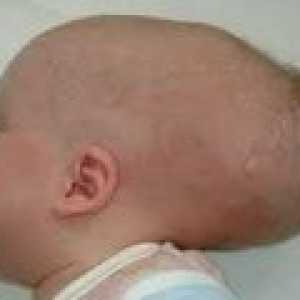 Prirojena hidrocefalus v otroka: vzroki, simptomi, zdravljenje