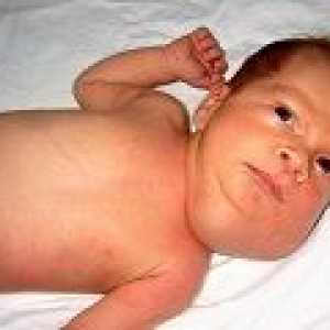 Prirojena lymphangioma otroka: simptomi in zdravljenje