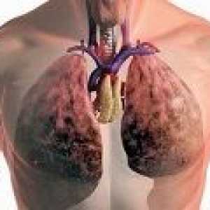 Vsi zdravljenje pljučne tuberkuloze