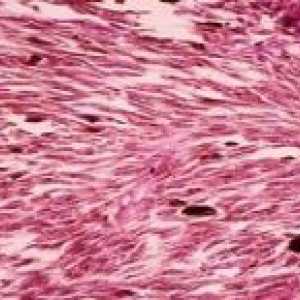 Značilnosti odkrivanje in zdravljenje vretena celic melanoma
