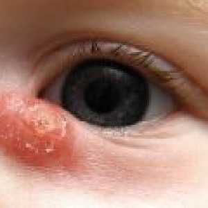 Bolezni solznega aparata pri otrocih