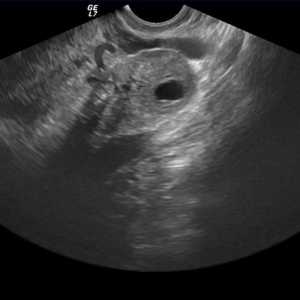 Rumeno telesce v jajčniku med nosečnostjo