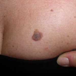 Maligni melanom: oblika in faza razvoja, zapletov, zdravljenje, preprečevanje